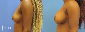 VPSI Before & After Breast Augmentation Patient 1a