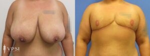 VPSI Before & After Female to Male Patient 3c