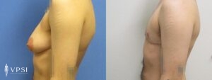 VPSI Before & After Female to Male Patient 5a