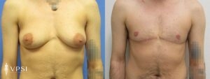 VPSI Before & After Female to Male Patient 5c