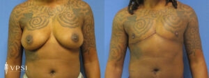 VPSI Before & After Female to Male Patient 6c1