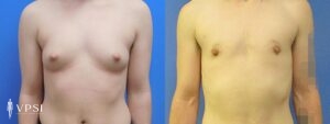VPSI Before & After Female to Male Patient 8c