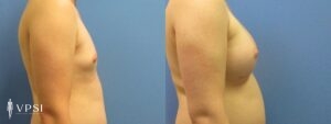 VPSI Before & Afters Male To Female Patient 6a