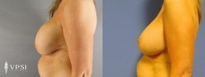VPSI Before & After Revision Augmentation Mastopexy Patient 1a