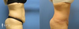 VPSI Before & After Tummy Tuck Patient 3b