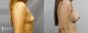 VPSI Before & After Breast Augmentation Patient 3b