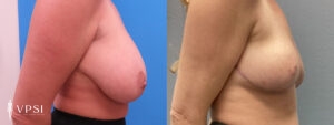 VPSI Before & Afters Breast Reduction Patient 1_a