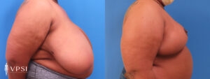 VPSI Before & Afters Breast Reduction Patient 2_a