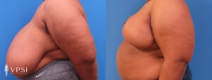 VPSI Before & Afters Breast Reduction Patient 2_b