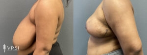 VPSI Before & Afters Breast Reduction Patient 3_b