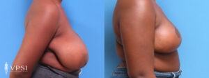 VPSI Before & Afters Breast Reduction Patient 4_a