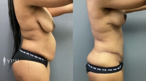 Vegas Mommy Makeover Before & After Patient 2a