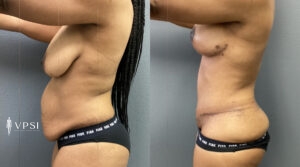 Vegas Mommy Makeover Before & After Patient 2b