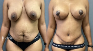 Vegas Mommy Makeover Before & After Patient 2c