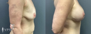 Vegas Before & After Breast Augmentation Patient 4a-1